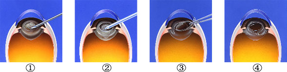 白内障の手術方法